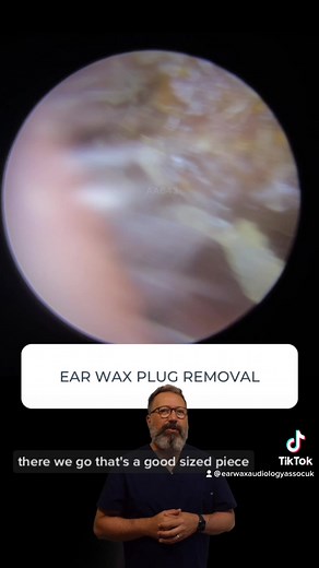 Ear Wax Plug Removal Procedure Explained by Audiologist