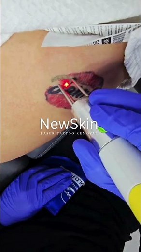 Laser Tattoo Removal near me San Antonio LiveOak TX | Black and Red Tattoo Removal Treatment Video