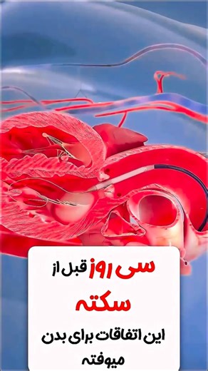 Clinics Bestskin on Instagram‎: "۴ نشانه قبل سکته🫀🧠 برای راهنمایی کامل کلمه «سکته» رو کامنت کن و پیجمو فالو کن💙 📩 @clinic.bestskin ۴ علامت پیش‌آگاهی سکته قبل از سکته — این ۴ علامت را جدی بگیرید 🚨 درد قفسه سینه با تنگی نفس؛ درد تیرکشنده به دست/فک/گردن یا مچ راست؛ عرق سرد، بی‌حسی و اضطراب ناگهانی؛ سرگیجه، تهوع و درد شکم @clinic.bestskin ———————————— #نشانه #سکته #قلب #طب_سنتی"‎