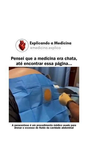 Victor Manoel | Explicando medicina | Saúde on Instagram: "Paracentese é um procedimento médico utilizado para retirar o excesso de líquido da cavidade abdominal, chamado ascite. Esse acúmulo pode causar inchaço, dor e dificuldade para respirar. 🔹 Para que serve? Alivia os sintomas do paciente e também permite analisar o líquido em laboratório para descobrir a causa do problema. 🔹 Como é feita? Após anestesia local, o profissional insere uma agulha ou cateter no abdômen, geralmente com auxílio