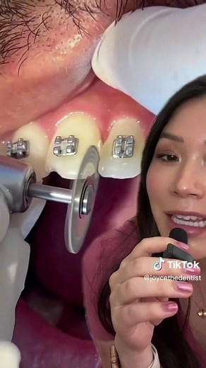 Understanding IPR in Dentistry: What You Need to Know