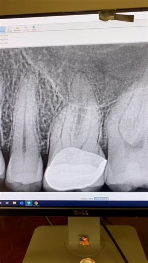 9K views · 69 reactions | #dentistry #dentalschool #dentists #rootcanaltherapy #hygienist | Advanced Micro-Endodontics | Facebook