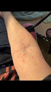 I get this rash on my right arm randomly every couple months for prob 10 years… doesn’t itch, or hurt. Comes and goes. What in the world is it?? #mystery #rash | RootsOf Healing