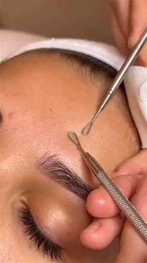 Zenpores on Instagram: "ASMR Dermatology: Side Forehead Blackhead Extraction (Steel Loop, No Talking, Visible Sebum Plugs) #ASMR #DermatologyASMR #ForeheadExtraction #BlackheadRemoval #VisiblePores #NoTalkingASMR #PoreCleaning #ASMRTriggers #SebumPlugs #DeepCleansing #SatisfyingVideo #LoopExtractor #SideForehead #RelaxationASMR #Tingles #SleepAid #FacialTreatment #CleanPores #RealisticExtraction #oddlysatisfying"