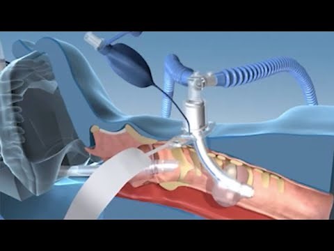 Portex® ULTRAperc® Percutaneous Dilation Tracheostomy Kit