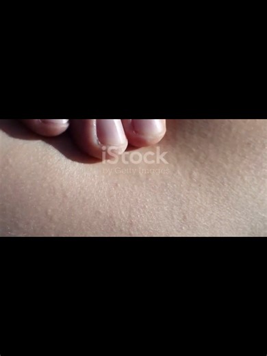 Raised scar growing beyond the original wound? It could be a keloid. Keloid scars form when the skin produces excess collagen during healing, leading to thick, raised scars that may itch or expand over time. In this video, I explain why they happen, who is at higher risk, and treatment options that may help reduce them. Guidance from dermatology groups like the American Academy of Dermatology highlights early management to limit growth and symptoms. Not all scars heal the same — understanding yo