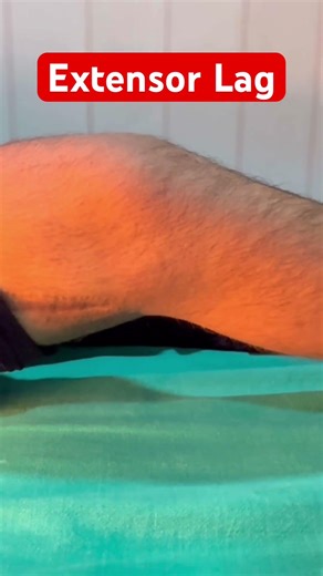 Extensor Lag in knee joint postoperative #reels #orthopedics #operation #muscle e