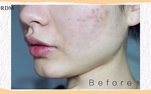 痘痘红肿还流脓？反反复复不见好？试试DRDM净透祛痘精华液，帮你祛痘淡印！