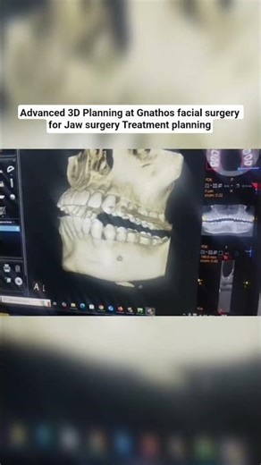 Advanced 3D Planning for Jaw Surgery | Gnathos Facial Surgery Treatment!