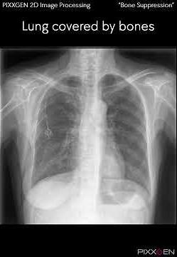 X Ray Detector by PIXXGEN 2D Image Processing