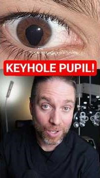 What Is A Keyhole Pupil? (Eye Coloboma)