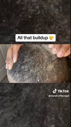 His hair needed to get scratched 🪮 What do you think it is? #dandruf...