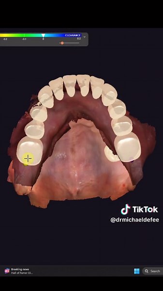 Have you ever wondered how to streamline the workflow for digital denture design? Todays top tip walks through how to save and reuse tooth setups with perfect occlusion and aesthetics in new cases to make digital denture design super efficient #exocad #digitaldentures #themodinstitute #digitaldentist