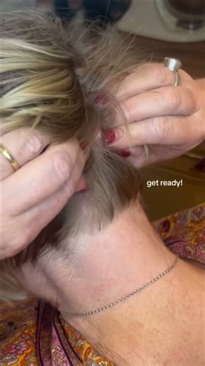 Popping a cyst on head