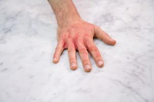 Don’t Let Hand Rashes Ruin Your Winter | Newswise