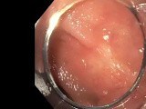 ESD Residual Adenoma Recti • Video • MEDtube.net