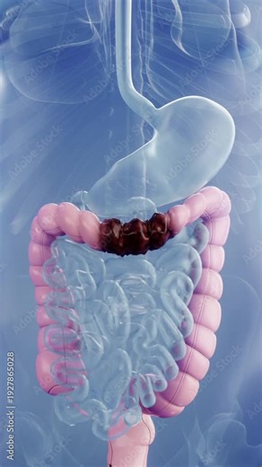 Rectal cancer, intestinal lesions and polyps growing inside, tumor cells enter the blood through blood vessel gaps and flow throughout the body along with red blood cells.Cancer progression, 3D render