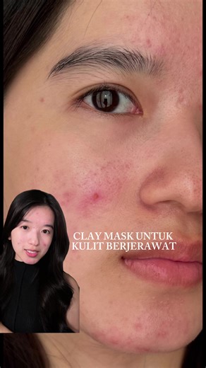 Rekomendasi Clay Mask Untuk Kulit Berjerawat