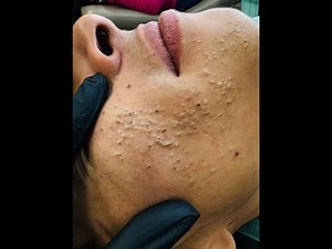 Acne Facial Routines - Deep Cleansing Remedies for a Flawless Face