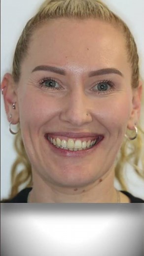 Before & After - Severe Teeth Crowding Transformation