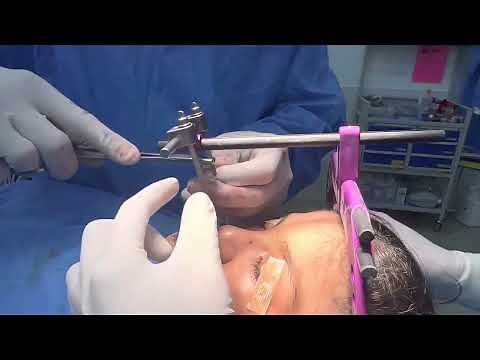 RED Rigid External Device Halo Martin Type Lefort one Distraction - Craniofacial Surgery in India