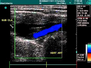 Vertebral Artery, Doppler Echography • Video • MEDtube.net