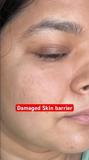 Sensitive Skin or Damaged Barrier? Why skincare burnsyour skin & moisturiser stings, heat on face