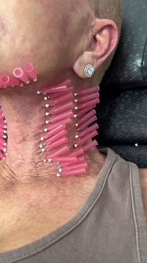 Smooth threads are AMAZING for building collagen 💕🪡 #threads #smooththreads #medspa #treatment