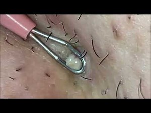 Large Blackheads Cystic Acne Blackheads&Whiteheads Removal Pimple Popping #11250