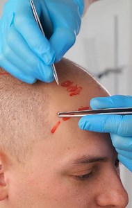 24K views · 31 reactions | Hair Transplant Procedure Steps and Health Techniques by Professionals! | 5-Minute Workouts | Facebook