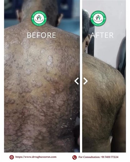 Chronic Psoriasis cured within 4 months | Dr Raghuveer SN | Ayurvedic Skin Care #psoriasistreatment