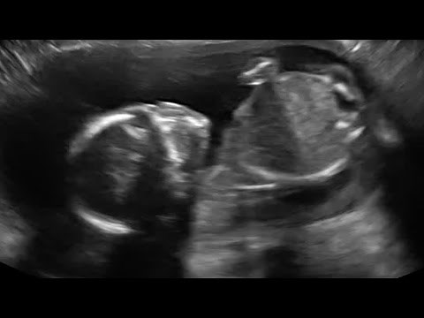 Ultrasound Shows Baby Boy Hitting Himself Whilst In The Womb