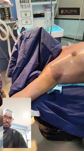 Gynecomastia Surgery