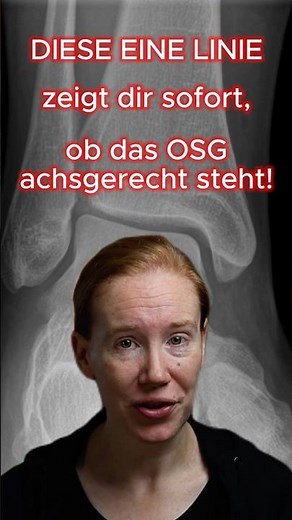 Die tibiotalare Linie im Röntgen OSG – schnell erklärt