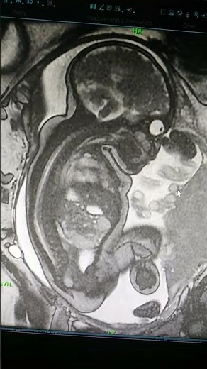 MRI in pregnancy, baby in MRI Scan, Radiology 😍