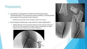 Pediatric Trauma - Upper Extremity: Clavicle Fracture, Sternoclavicular Joint, Humerus Fracture