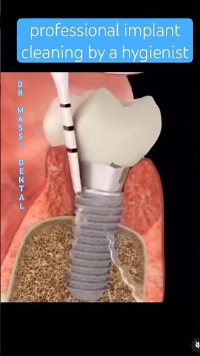 professional implant cleaning by a hygienist