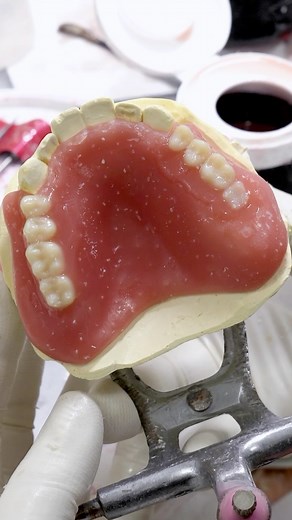 DENTRION I 덴트리온 | Digital Temporary Dentures👏 . #dentures #3DPrintedDenture #temporarydenture | Instagram