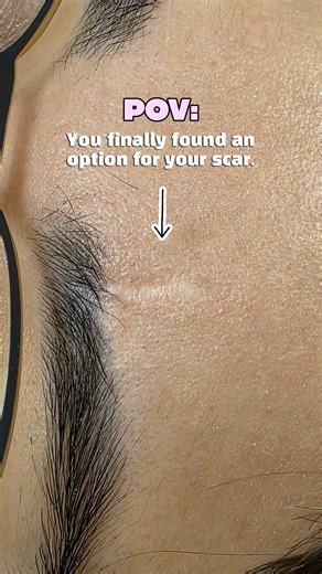 Scar Camouflage Tattooing: Watch Us Blend This Scar With Flesh-Tone Ink
