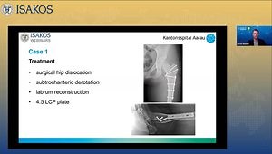 How I Do It: Correction of Femoral Version Abnormalities in Patients With FAI