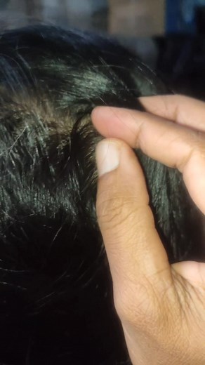 Let's get rid of the fleas. #lice | Life Story