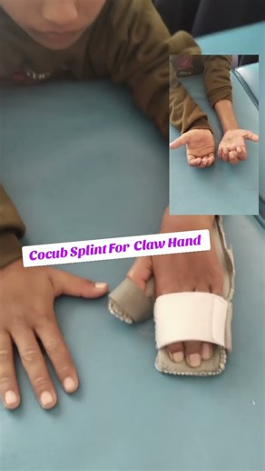 Cocub Splint For Claw Hand to Improve the ROM. #foryou#physiotherapist#motivation#doctor #wubbles