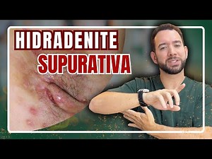 HIDRADENITIS SUPURATIVA: Understand the causes, symptoms and treatment | Dr. Gabriel Renato