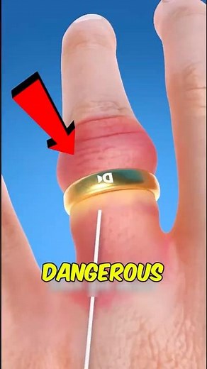 Your Ring Is Stuck? NEVER Pull It Off Like This! 💍😨