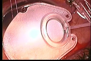 Supra-Tenon Placement of Molteno3 Glaucoma Implant - Eyetube