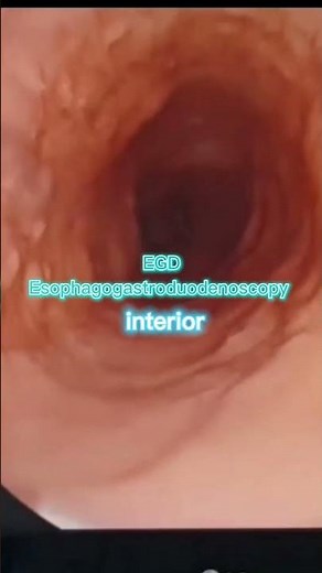 EGD ESOPHAGOGASTRODUODENOSCOPY - MEDICAL DEFINITION | Medical Consecutive Interpreting