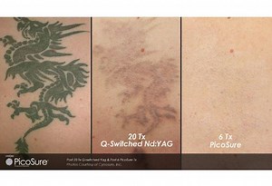 Dr William Frazier Explains the Importance of Using a Doctor to Remove Tattoos