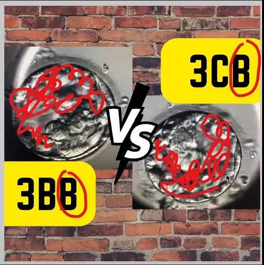 3BB vs 3CB Embryo Grading Comparison: Which is Better for Transfer?