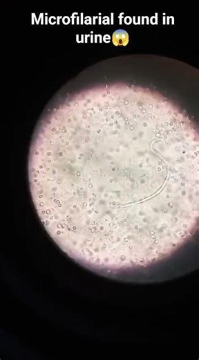 🔬🦠Microfilaria found in Urine#microscope #laboratory #science #medical #microbiology #urineproblem