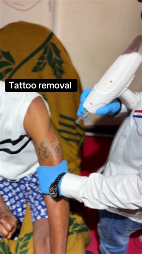 Laser tattoo removal first session